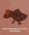 День меланоми 2018 – приходьте 20 квітня на безкоштовний огляд родимок в своєму місті